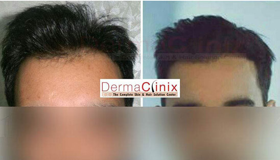Best Hair Transplant Clinic in Kuala Lumpur, Top Hair Doctors: DermaClinix