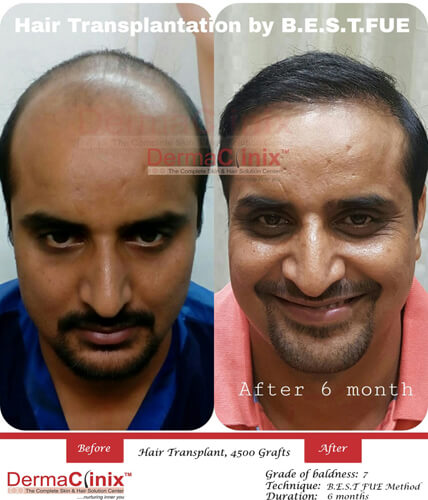 Hair Transplant Results Before After Photos in Kuala Lumpur - DermaClinix